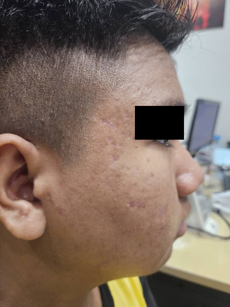 Facial acne after treatment